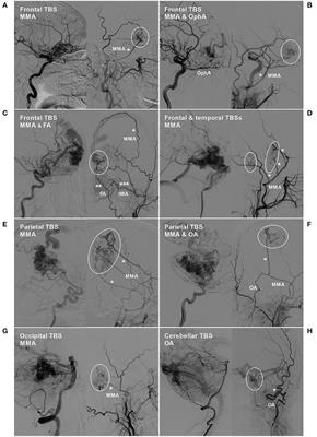 Angiographic Evaluation and Endovascular Treatment Considerations of Brain Arteriovenous Malformations With a Transdural Blood Supply: A Single-Center Experience